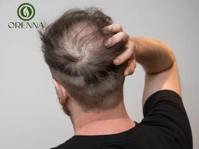 nguyên nhân rụng tóc ở nam