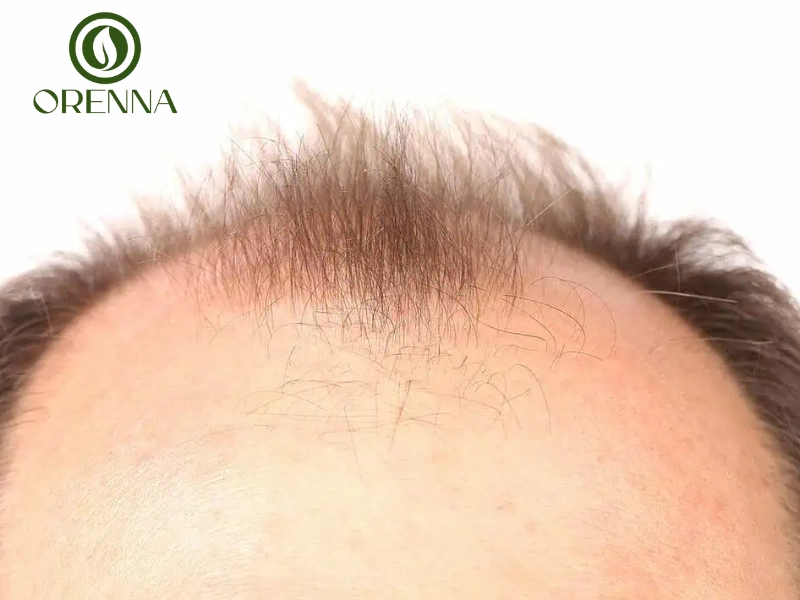 Dấu hiệu nhận biết sớm đầu hói