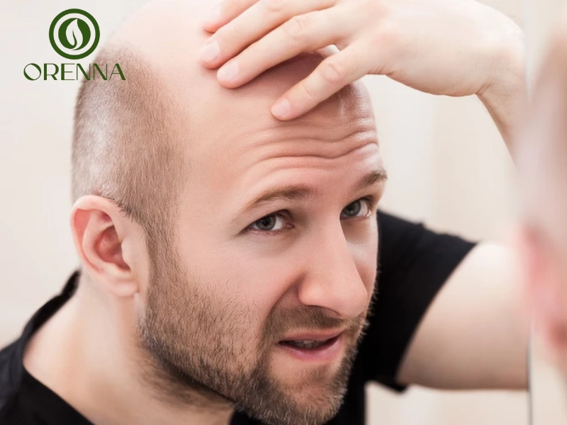 Nguyên nhân gây đầu hói phổ biến