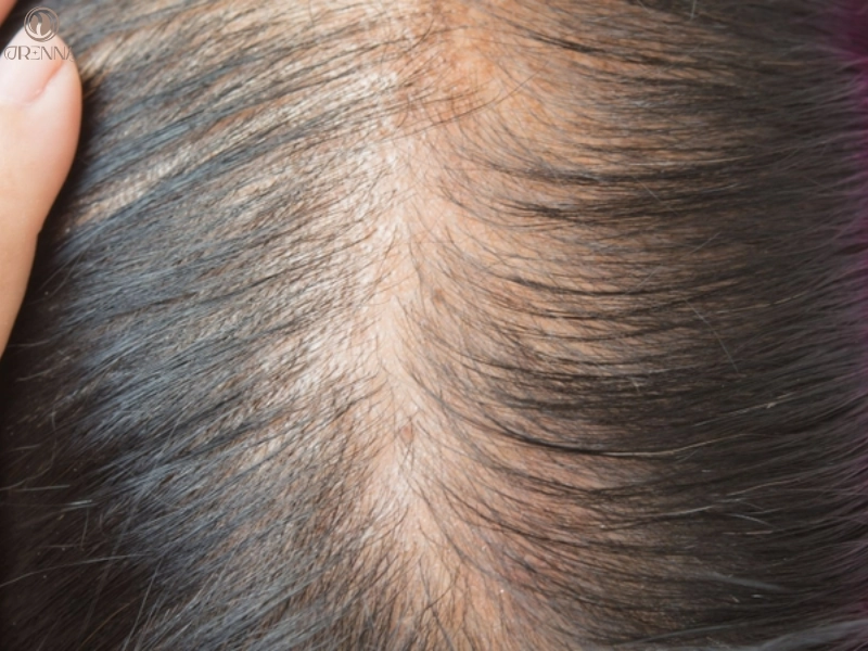 Dấu hiệu nhận biết tóc yếu và mỏng