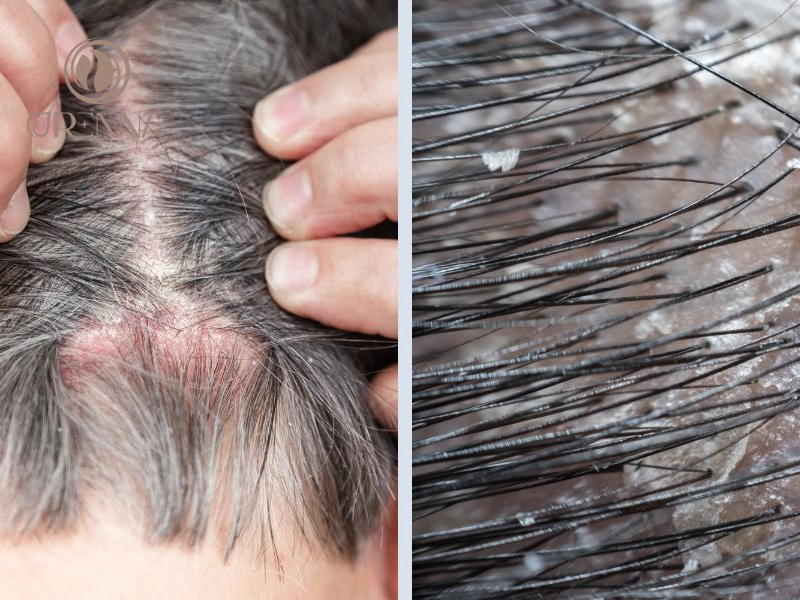 Nấm Malassezia globosa phát triển quá mức và gây ra đầu nhiều gàu