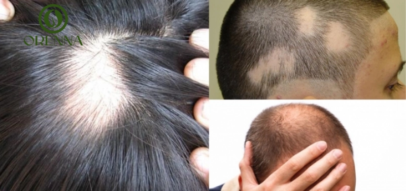 Mất chân tóc có mọc lại không