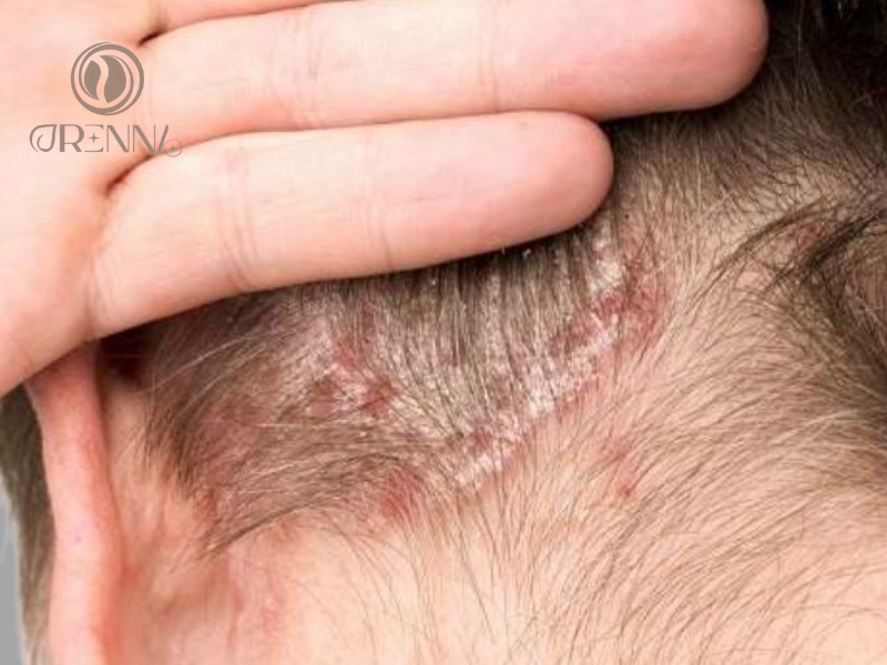 Hoá chất trong các sản phẩm dầu gội, dầu xả,... có thể gây kích ứng da đầu và dẫn đến đầu gàu nhiều