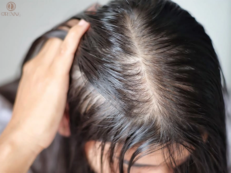 Cách nhận biết da đầu yếu và tình trạng rụng tóc nghiêm trọng