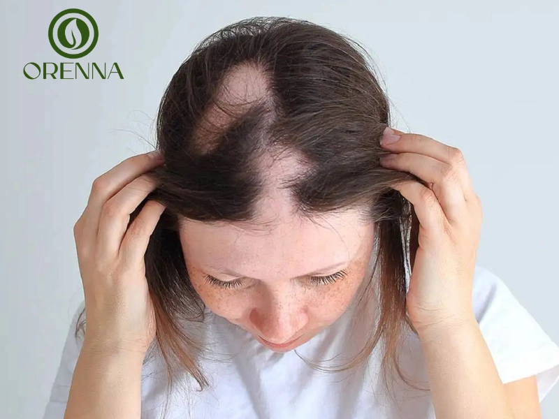 Các phương pháp điều trị rụng tóc từng mảng hiện nay