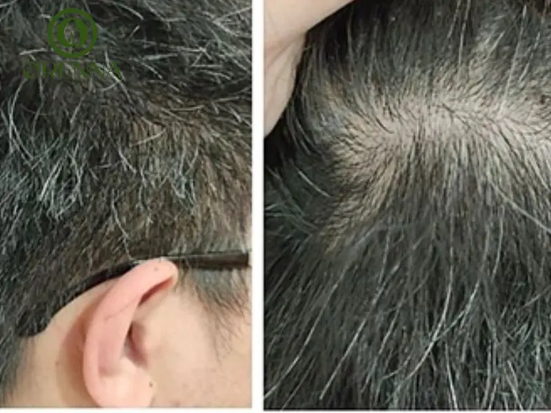 Phân biệt tóc bạc tự nhiên và tóc bạc sớm