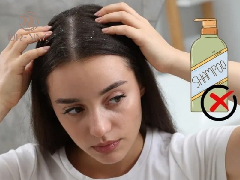 Các thành phần cần tránh tuyệt đối khi bị gàu