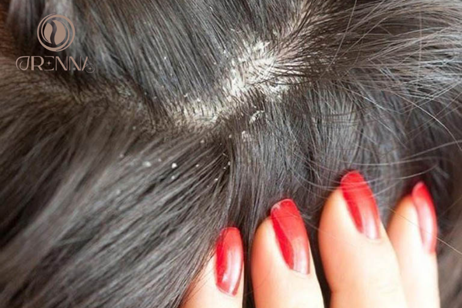 Top 7+ Dầu Gội Sạch Gàu Hiệu Quả, An Toàn Cho Da Đầu Nhạy Cảm