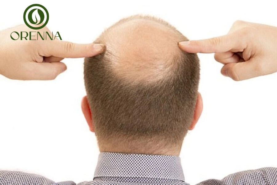 Nguyên Nhân Hói Đầu: 7 Lý Do Thường Gặp Và Cách Khắc Phục