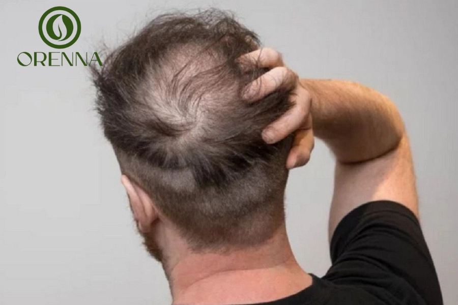 Cách Trị Hói Đầu Nam Giới An Toàn, Hiệu Quả Nhất Hiện Nay
