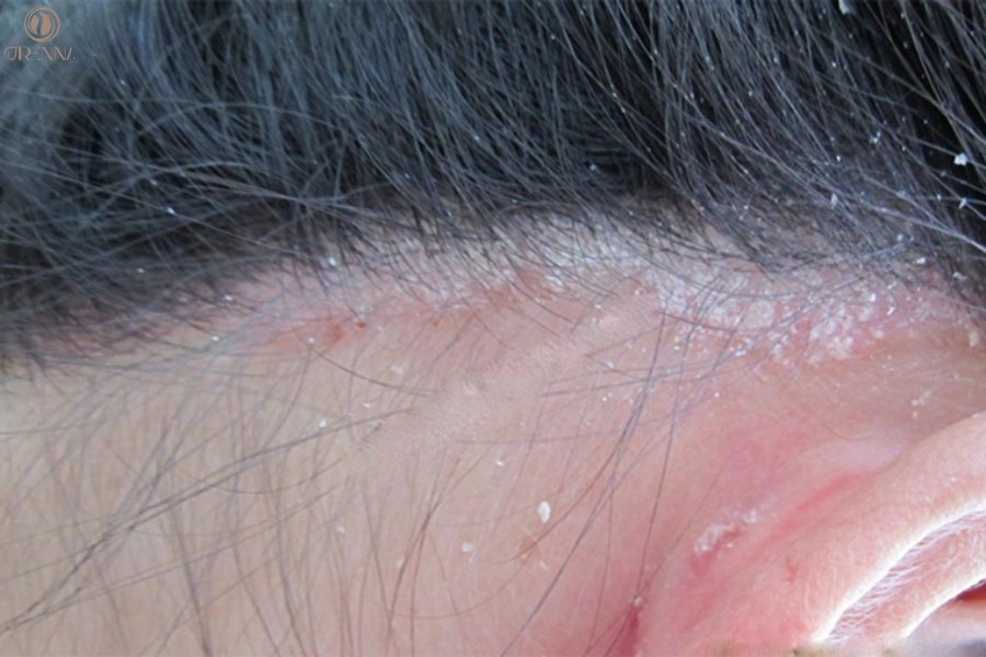 Da Đầu Có Vảy Trắng Không Ngứa: Nguyên Nhân, Giải Pháp Hỗ Trợ Hiệu Quả 