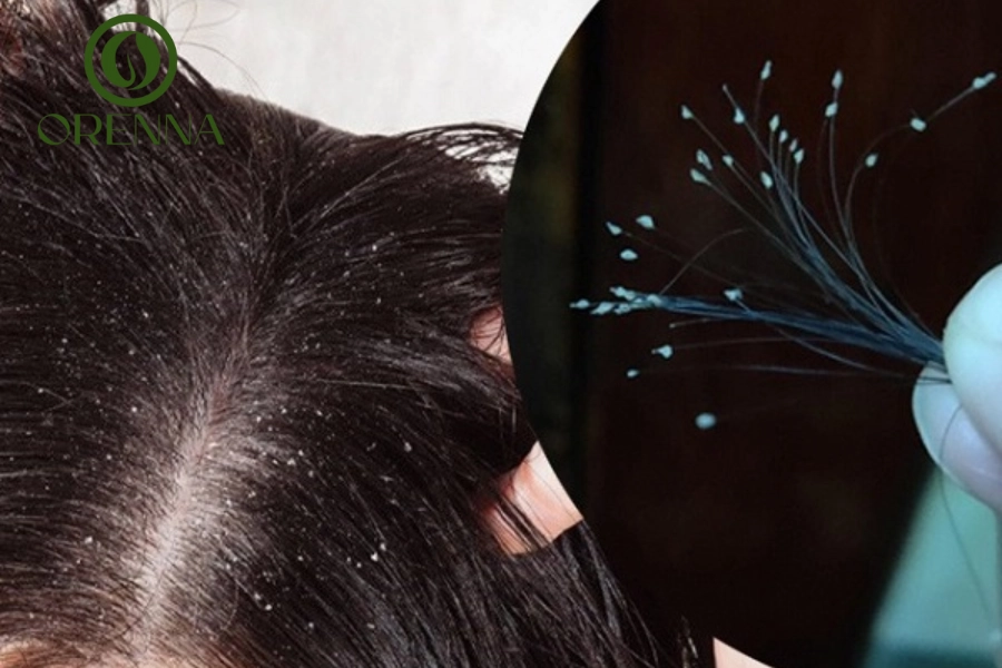 Mất Chân Tóc Có Mọc Lại Không? Giải Pháp Giúp Mọc Tóc Nhanh An Toàn