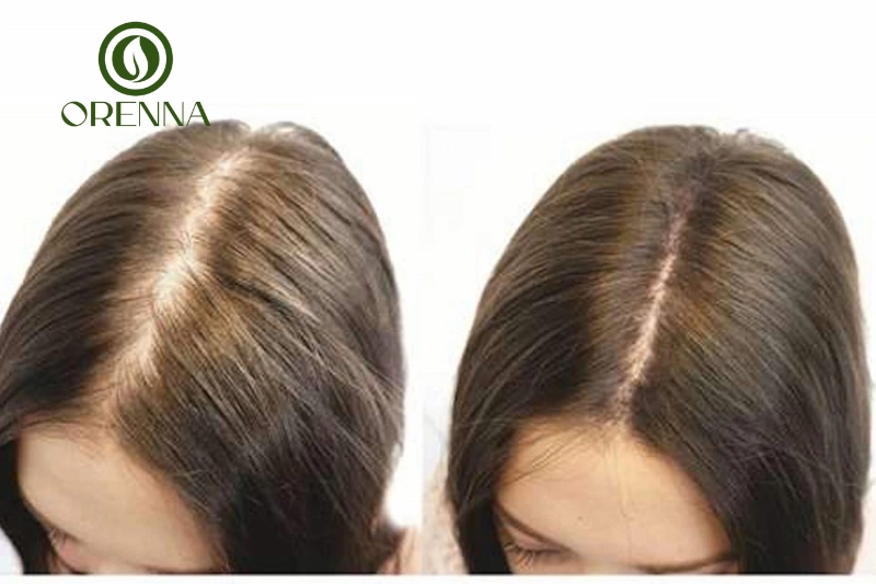 Những lưu ý quan trọng khi điều trị hói đầu