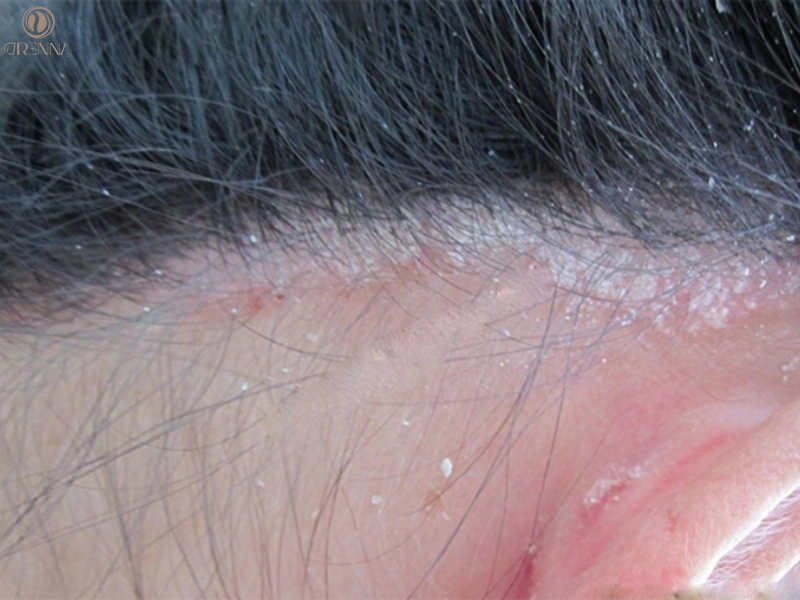 Da đầu có vảy trắng không ngứa là gì? Phân biệt với gàu thông thường