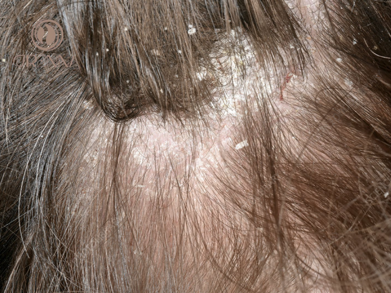 Gàu do nấm/Viêm da tiết bã