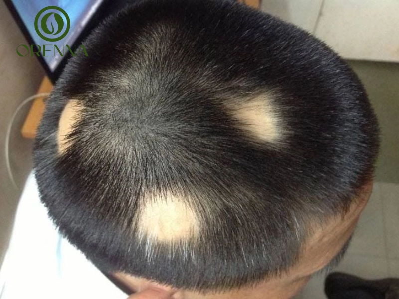 Rụng tóc từng mảng là gì và có mọc lại được không?