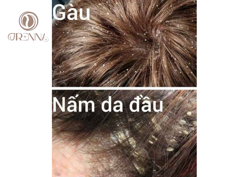 So sánh Gàu thông thường và Mảng gàu do viêm da tiết bã