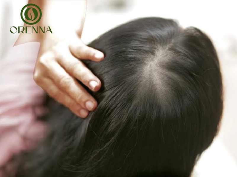 Hói đỉnh đầu ở nữ và dấu hiệu nhận biết sớm