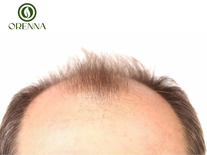 Hói giữa đầu và dấu hiệu nhận biết sớm