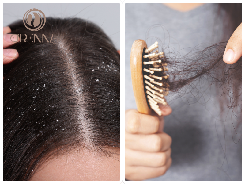 Bị gàu có gây rụng tóc không?