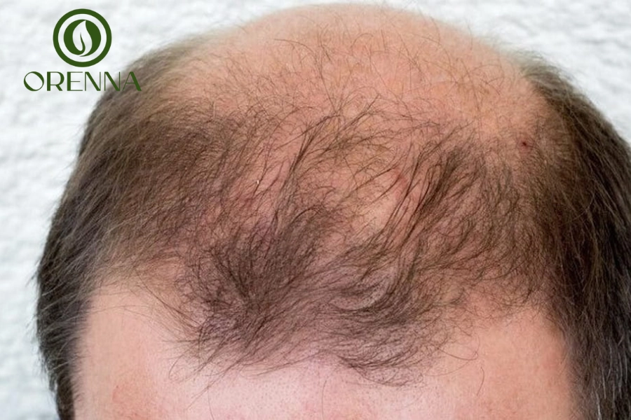 Nguyên Nhân Bị Hói Giữa Đầu Và Cách Khắc Phục Hiệu Quả