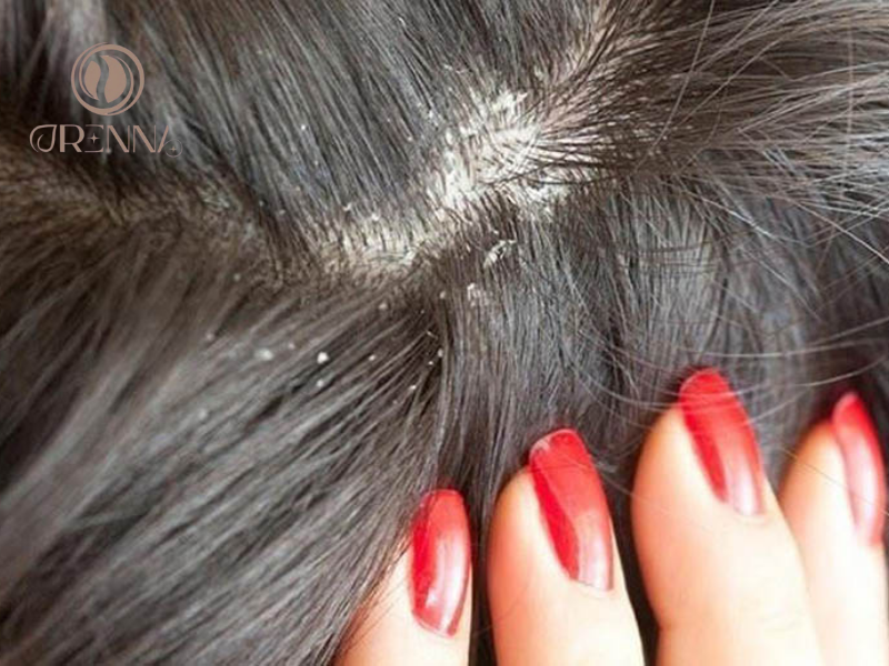 Nguyên nhân của gàu là từ đâu?