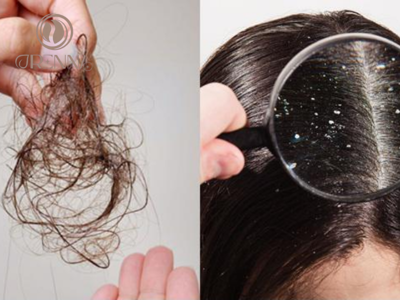 Nguyên nhân bị gàu và rụng tóc là gì?