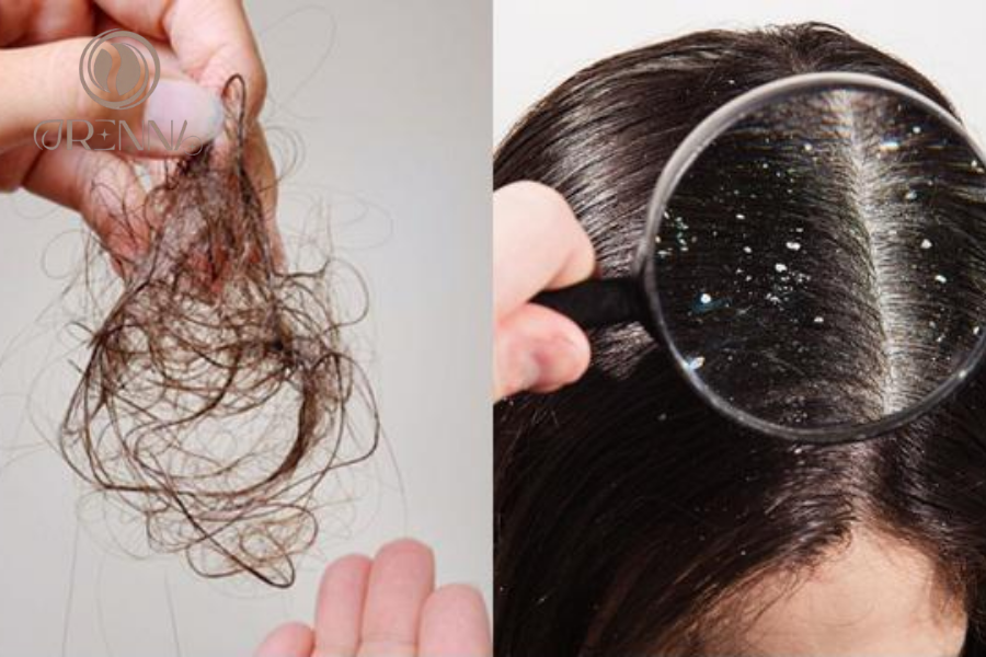 Nguyên nhân bị gàu và rụng tóc là gì? Cách chăm sóc đúng từ tế bào gốc nang tóc