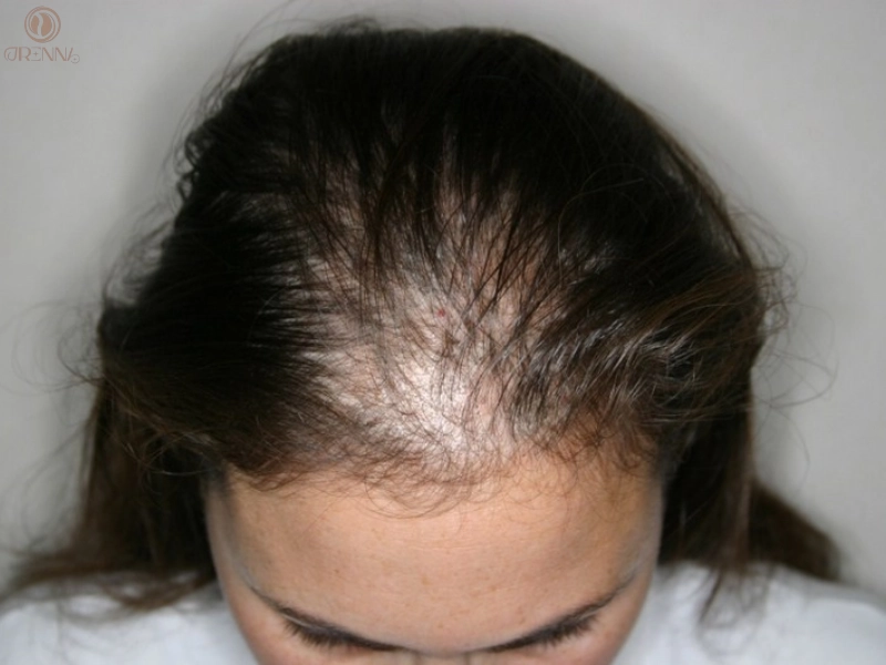 Nguyên nhân khiến tóc trở nên yếu và mỏng