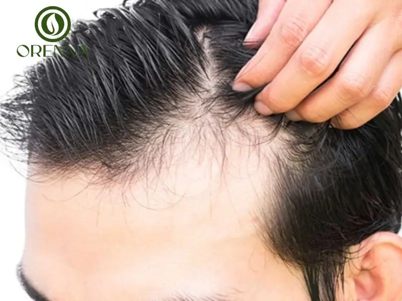 Lưu ý quan trọng khi khắc phục hói chữ M