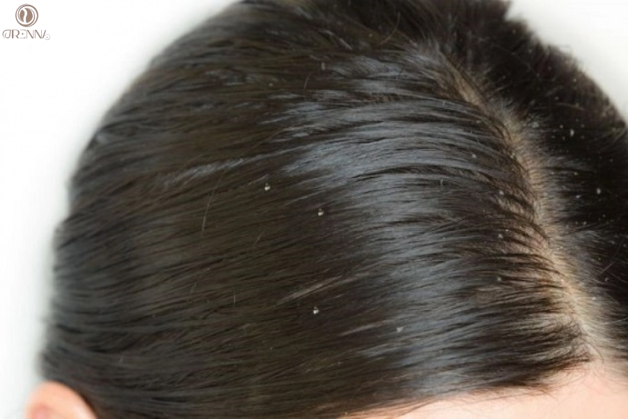 Tóc Gội 1 Ngày Đã Bết: Nguyên Nhân Và Giải Pháp Khắc Phục Hiệu Quả 