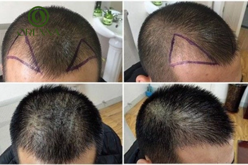 Cấy tóc là phương pháp phổ biến trị hói chữ M