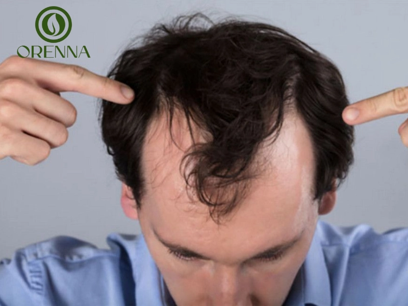 Cách phòng ngừa hói đầu nam giới