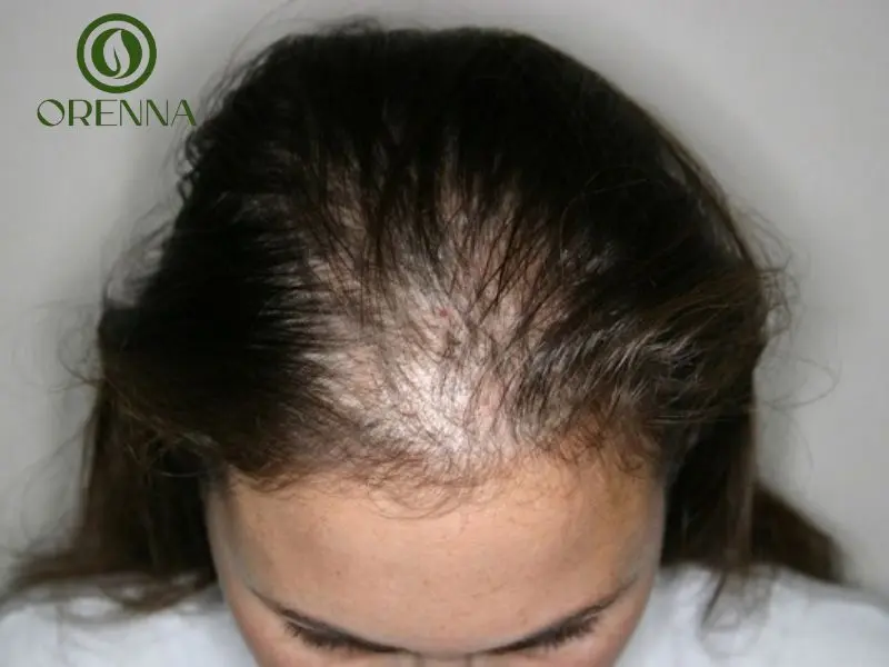 rụng tóc nhiều ở nữ