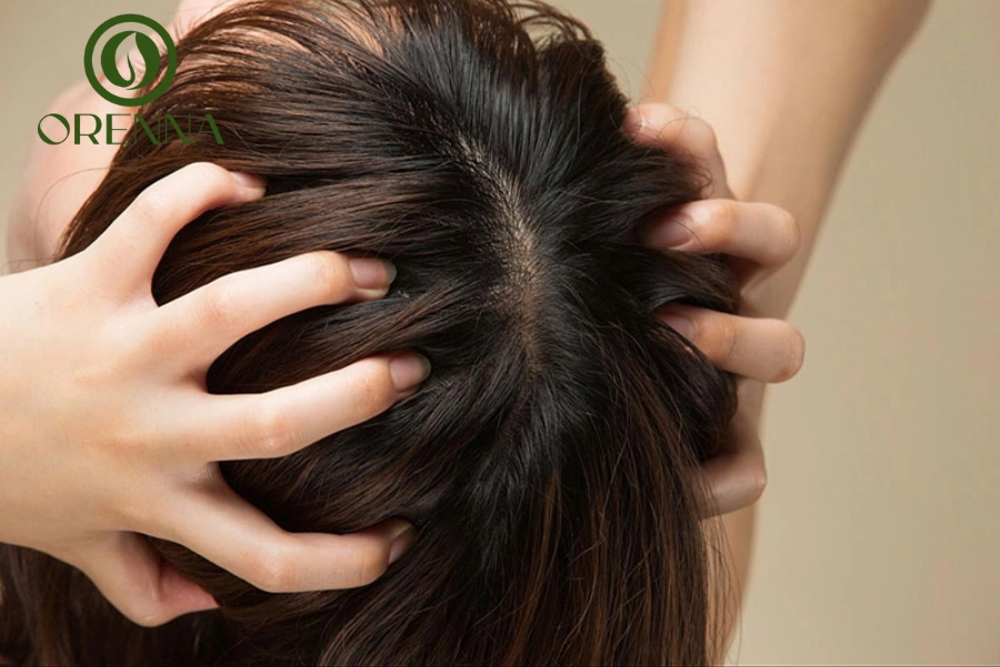 Bị Hói Đỉnh Đầu: Nguyên Nhân, Dấu Hiệu Và Cách Khắc Phục Hiệu Quả