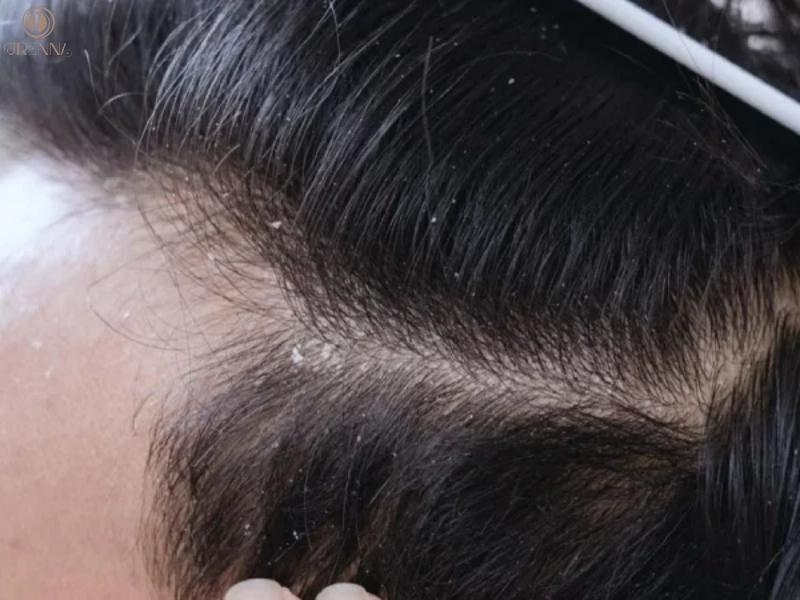 Nguyên nhân chính gây ra tình trạng da đầu có vảy trắng không ngứa