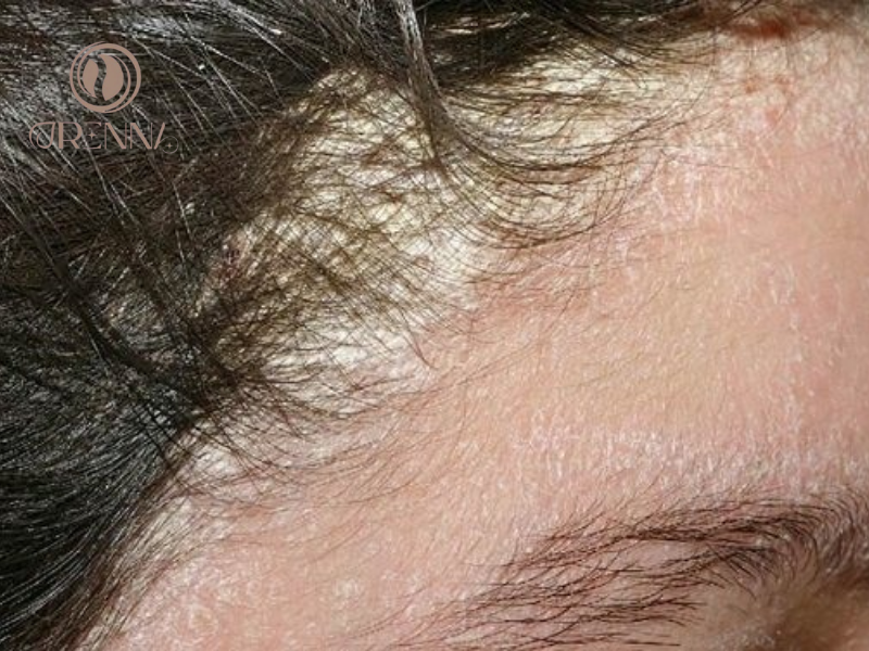 Mảng gàu trên da đầu là gì?