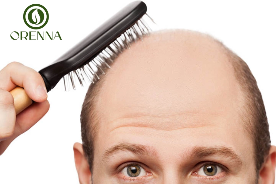 Hói Có Di Truyền Không? Nguyên Nhân Và Cách Khắc Phục Hiệu Quả