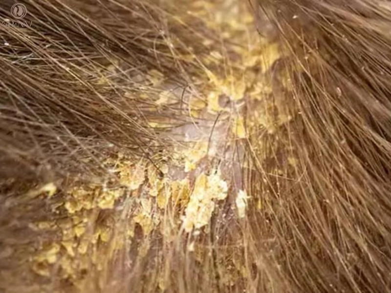 Gàu ướt là gì và tại sao bạn cần quan tâm?