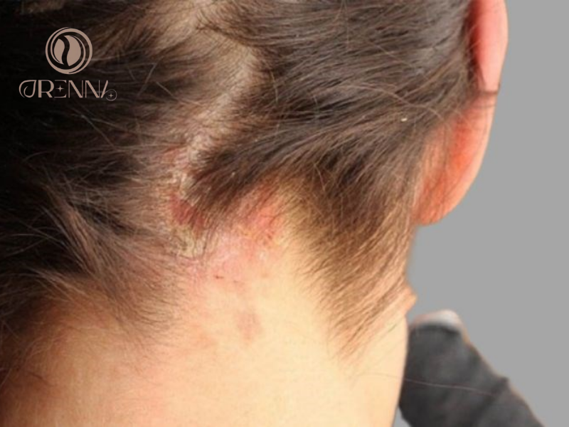 Gàu do phản ứng sản phẩm