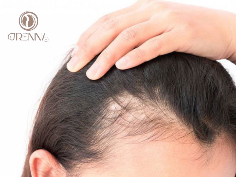 Da đầu khô là một trong những nguyên nhân khiến đầu nhiều gàu