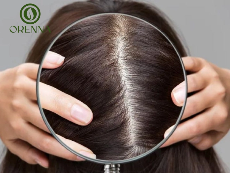 Khám phá nguyên nhân gây hói đỉnh đầu ở nữ giới