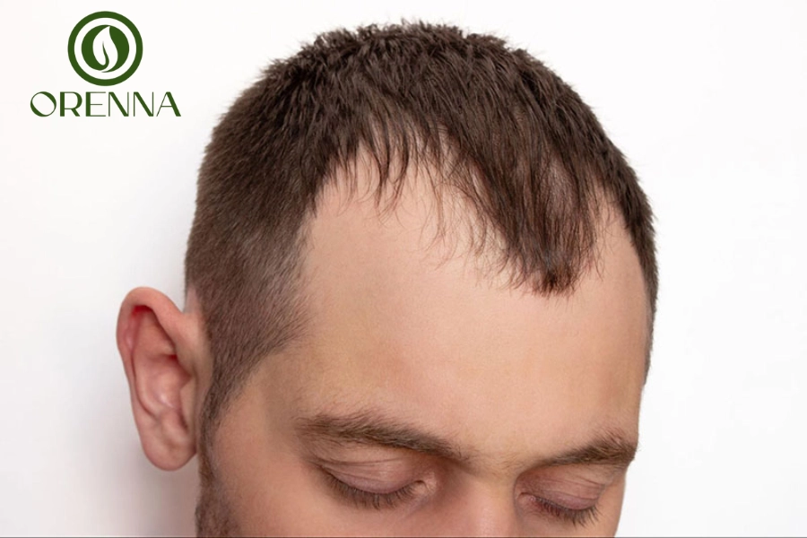 Hói Chữ M Có Chữa Được Không? Giải Đáp Ngay