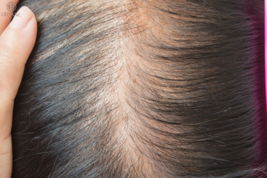 Sợi Tóc Mảnh Và Yếu: Nguyên Nhân Và Giải Pháp Giúp Tóc Chắc Khỏe, Bồng Bềnh