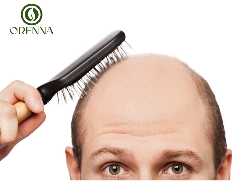 Bệnh hói đầu có di truyền không?