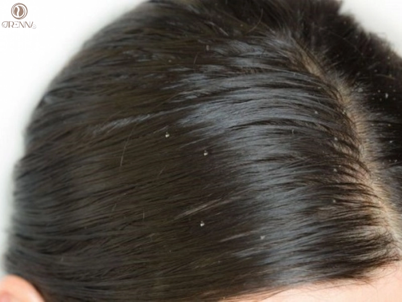 Tại sao tóc gội 1 ngày đã bết? Những nguyên nhân phổ biến cần biết