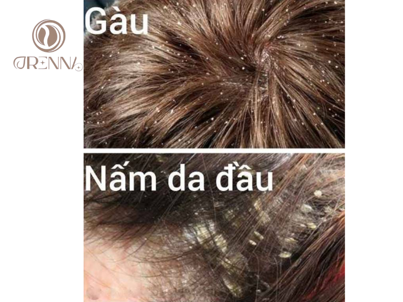 Phân biệt gàu thông thường với viêm da tiết bã