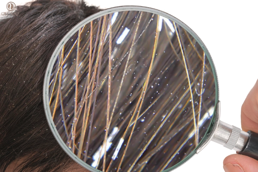 Nguyên Nhân Gàu Ống Trên Tóc Và Giải Pháp Hỗ Trợ Giảm Rụng Tóc Hiệu Quả