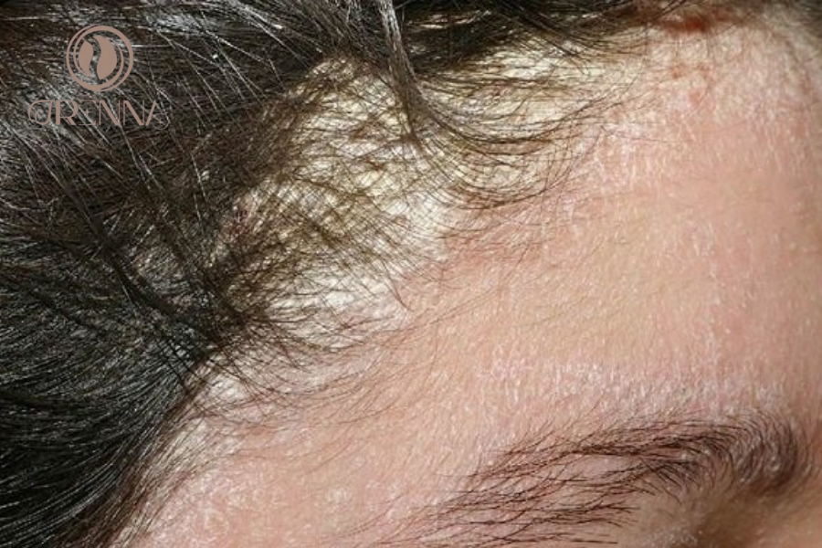 Nguyên Nhân Của Mảng Gàu Trên Da Đầu Là Gì? Cách Khắc Phục Hiệu Quả