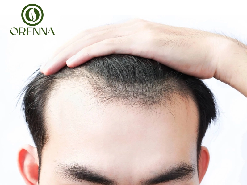 Chữa hói đầu di truyền có khó không?